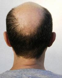 गंजेपन के चकत्ते Alopecia or Patchy Baldness ठीक हो सकते हैं